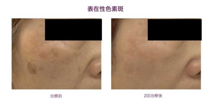 表在性色素班の施術事例