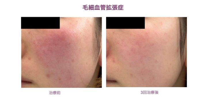 毛細血管拡張症の施術事例